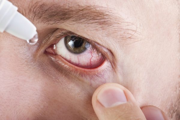 What Causes Eye Dryness? featured image